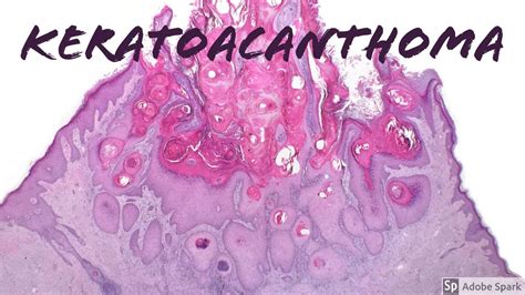 Keratoacanthoma Histology