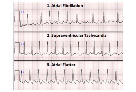 Aflutter Vs Svt Atrial Fibrillation And Atrial Flutter Heart And