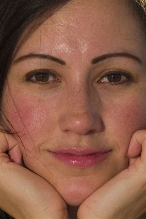 Rosy Cheeks Causes And What To Do