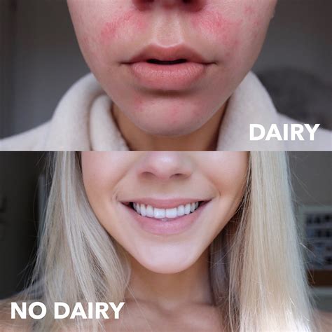Is Dairy Causing Your Skin To Breakout