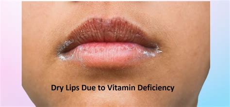 Dry Lips Vitamin Deficiency How Vitamin Deficiency Could Be The Hidden