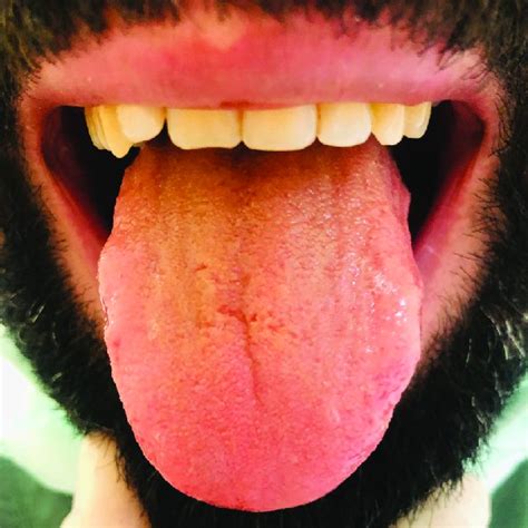 Geographic And Fissuring Appearance Of Tongue Download Scientific Diagram