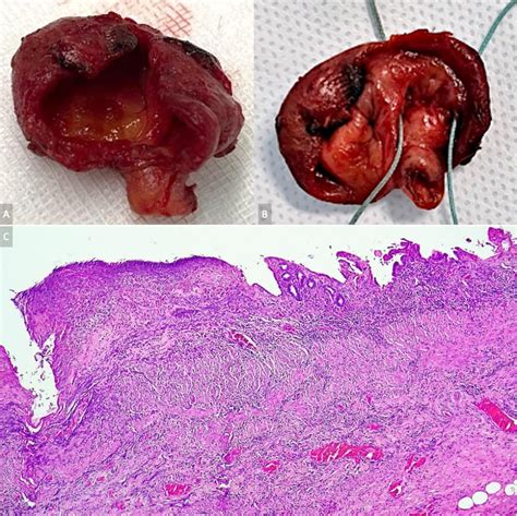 Figure 4 From The Curious Case Of The Choledochal CystRevisiting The