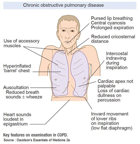 Chronic Obstructive Pulmonary Diseasewhat To Know