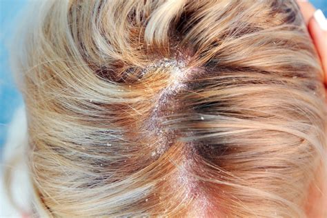 What Causes Scalp Fungus And The Best Treatment That Works Instantly