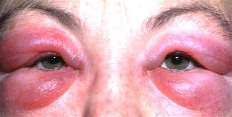 Conjunctivitis Allergic Tanner Eyes