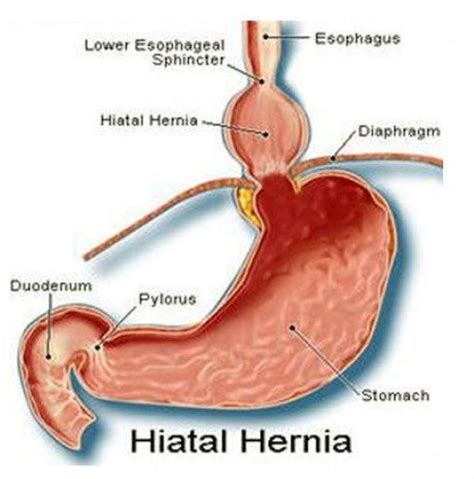 8 Types Of Hernia Symptoms In Both Men And Women And Treatments
