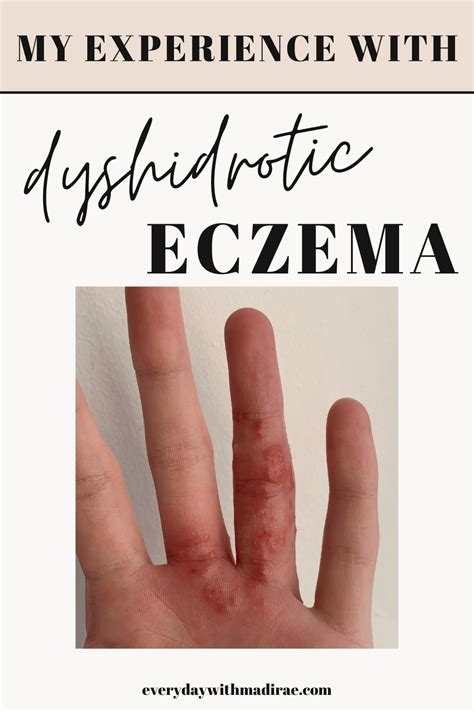 My Experience Dealing With Dyshidrotic Eczema Pompholyx In 2021