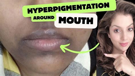 Hyperpigmentation Around The Mouth Treatment And Causes Youtube