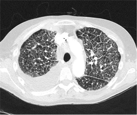 Ct Chest Demonstrating Bilateral Diffuse Interstitial Opacity And