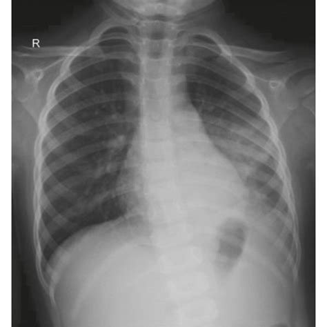 Cxr Ap And Lateral View Demonstrating Focal Area Of Consolidation In