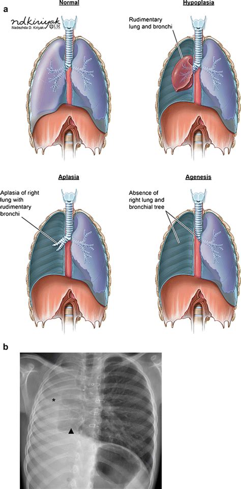 Beyond Bronchitis A Review Of The Congenital And Acquired