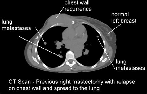Value Of Post Operative Chest Wall Radiation