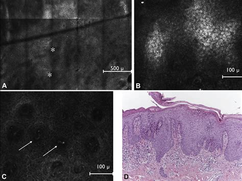 Dermoscopy And Confocal Microscopy Clues In The Diagnosis Of Psoriasis