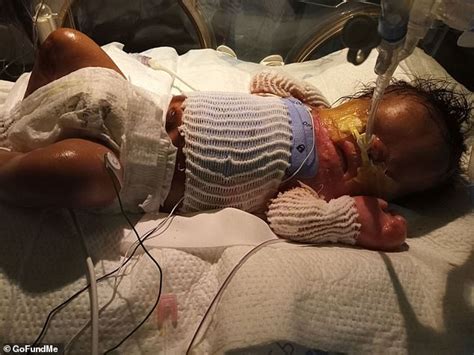 Three Month Old Baby Boy Born Without Skin Below The Neck To Get Life