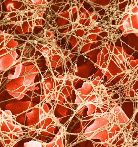 Several specific health conditions can cause blood clots. Blood Clot Sem, 2 Of 3 Photograph by David M. Phillips