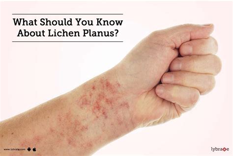 What Should You Know About Lichen Planus By Dr Akhilesh Sharma