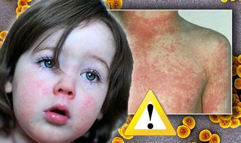 Scarlet Fever Outbreak Infection Cases Rise In Uk Symptoms And Signs