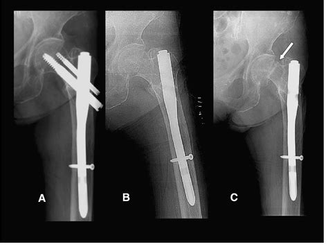Figure 2 From Subcapital Femoral Neck Fracture After Removal Of Gamma