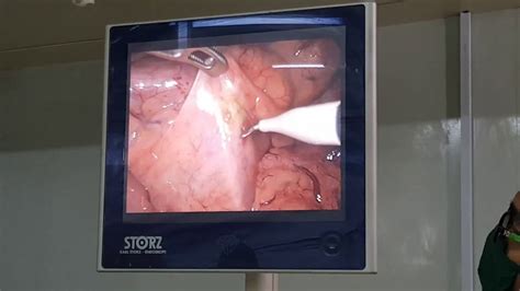 Possible complications when performing liver biopsy. Diagnostic Laparoscopy + Liver Biopsy + LN Biopsy - YouTube
