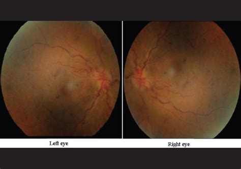 Bilateral Optic Disc Swelling With Retinal Hyperemia Optic Disc
