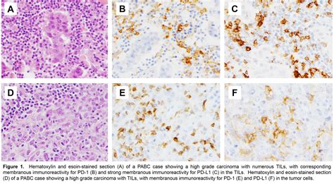 Pd L1 Expression In Tumor Infiltrating Lymphocytes In Pregnancy