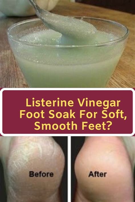 Listerine Vinegar Foot Soak For Soft Smooth Feet In 2020 Foot Soak Vinegar Foot Soak