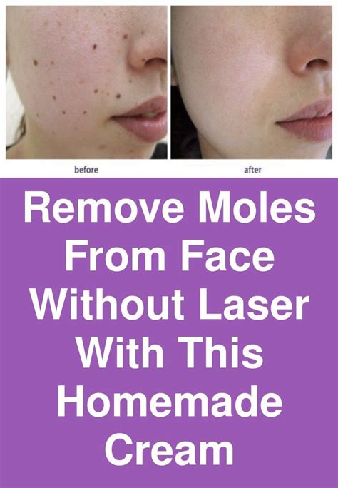 How To Remove Moles From Face Using Honey Howtoremvo