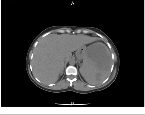 Figure From A Case Of Multiple Splenic Abscesses Due To Enterococcus
