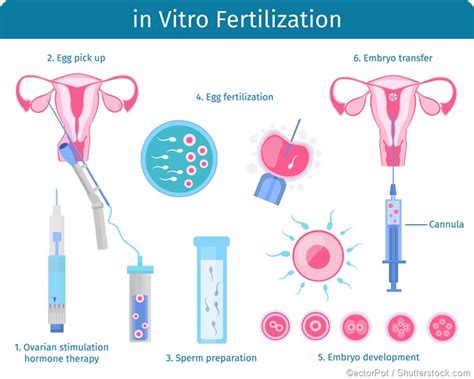 Intrauterine Insemination Iui Vs Ivf