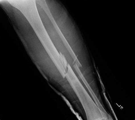 The Management Of Open Tibial Shaft Fractures The Bmj