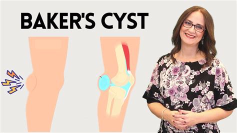 Four Easy Ways To Treating A Baker S Cyst Popliteal Cyst Youtube