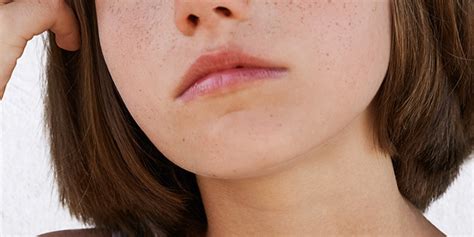 How To Get Rid Of Freckles On Your Lips