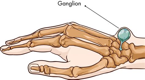 What Are The Different Types Of Ganglion Cyst Surgery Images And
