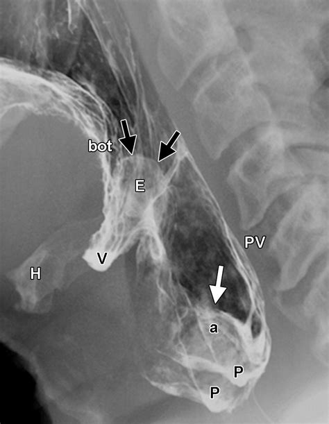 Easier To Swallow Pictorial Review Of Structural Findings Of The