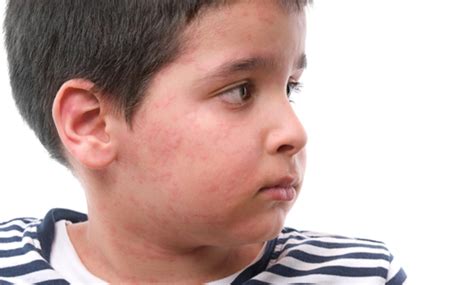 4 Common Causes Of Skin Allergy In Children Tata 1mg Capsules