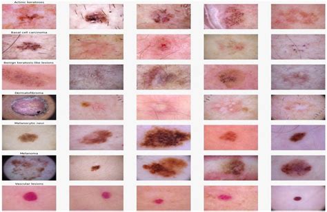 Stages Of Skin Cancer Download Scientific Diagram