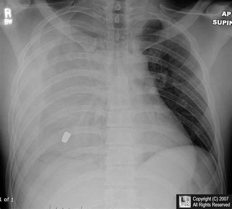 Tension pneumothorax was not clinically diagnosed as the cause of. Hemothorax. Causes, symptoms, treatment Hemothorax