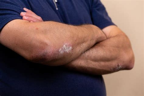 Close Up Allergic Rash Dermatitis Eczema On Skin Stock Photo Image Of