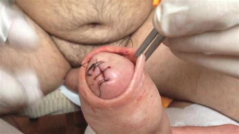 Cbt Sutures Gay Bizarre Porn At Thisvid Tube