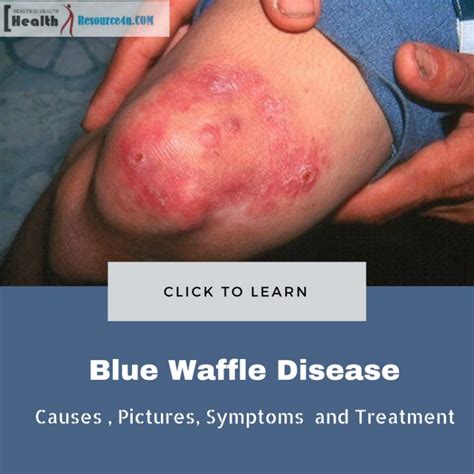Blue Waffle Disease Nedir