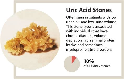 Can Kidney Stones Cause Protein In Urine - ProteinProGuide.com
