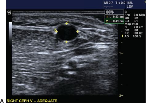 Preoperative Vein Mapping Thoracic Key