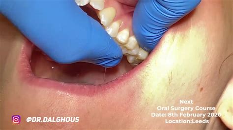 Ul8 Wisdom Tooth Extraction By Specialist Oral Surgeon Dr Abdul