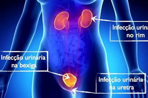 6 Sintomas Comuns De Infecção Urinária Com Teste Online Tua Saúde