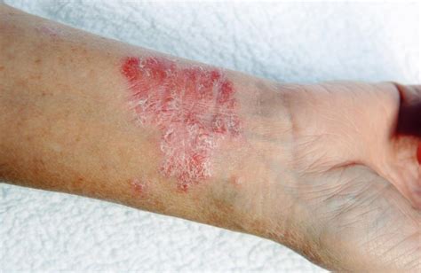 Psoriasis On The Wrist Sbd Resp