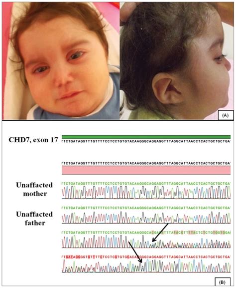 Three Novel Mutations Of Chd7 Gene In Two Turkish Patients With Charge