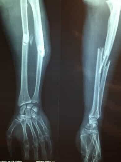 Leg Compound Fracture X Ray Foto Kolekcija