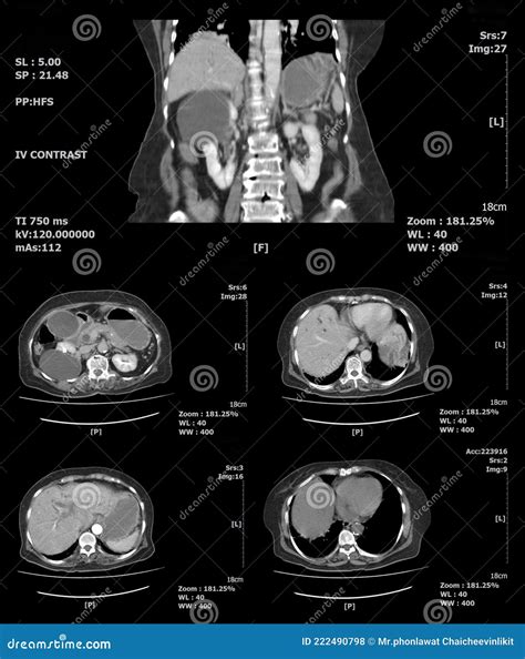 Ct Scan Abdomen And Body Stock Photo Image Of Kidney 222490798