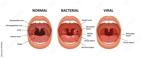 Bacterial Tonsillitis Tongue